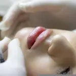 Filler labbra: guida al trattamento di medicina estetica